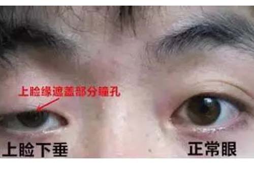 眼睑下垂矫正手术需要多少钱