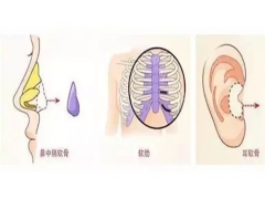 自体软骨隆鼻整形手术材料来源哪里