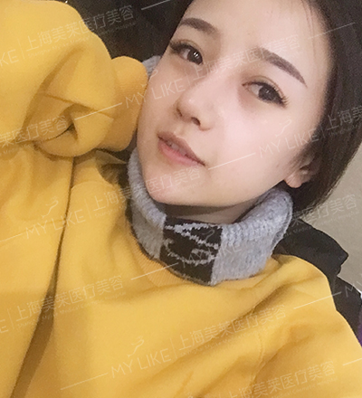 颖儿美莱韩式小翘鼻