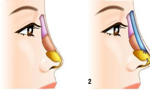 假体隆鼻整形术后会不会留下难看的疤痕