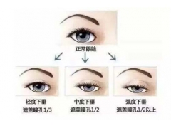 上眼皮松弛矫正手术价格是多少