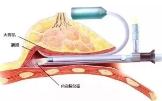 内窥镜丰胸的优势