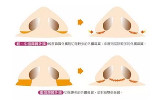 鼻翼缩小的方法,鼻翼缩小适合哪些人群