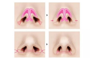 鼻翼缩小的方法，鼻翼缩小适合哪些人群