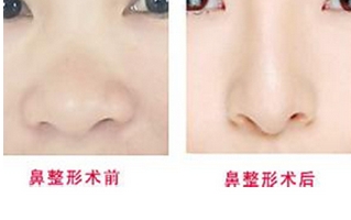 学生怎么鼻翼缩小,鼻翼缩小注意事项