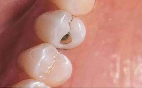 什么是牙结石，应该怎么治疗