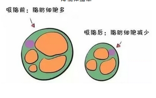 吸脂手术伤身体吗,吸脂会反弹吗