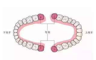 什么情况需要拔智齿