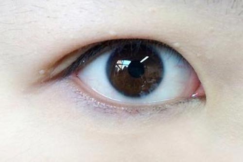 近视可以做双眼皮手术吗