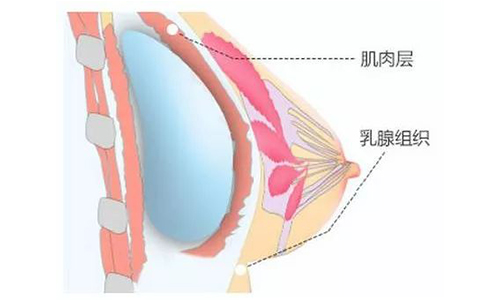 做假体隆胸整形手术会不会有什么危险