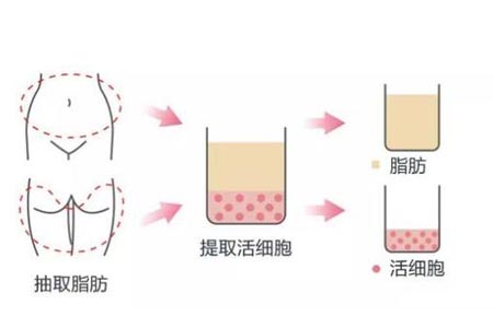 自体脂肪填充的自然吗