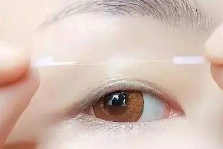 埋线双眼皮整形手术的优势是什么