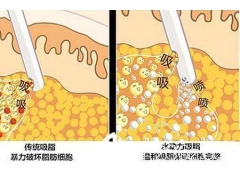 做抽脂减肥手术真的有减肥吗