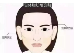 我的脸很大,为什么医生建议我做自体脂肪面部填充
