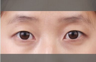 不能做双眼皮的眼睛图