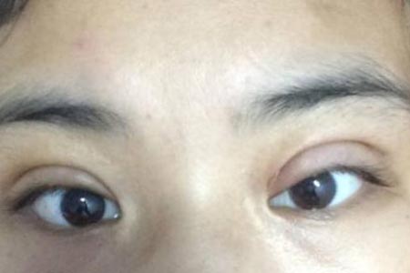 为什么双眼皮整形价格这么贵
