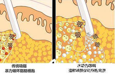 做吸脂减肥手术一次能瘦多少