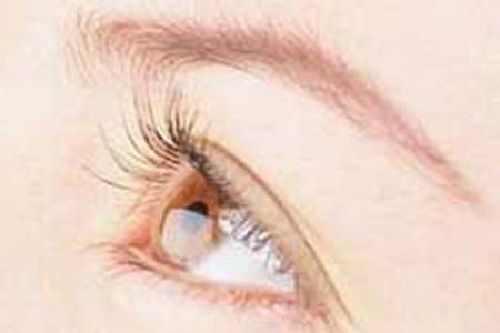 埋线双眼皮手术主要有哪些优势