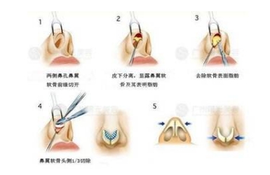 鼻头大可以缩小吗