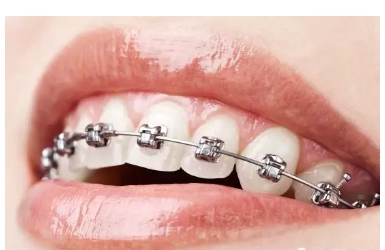 牙齿矫正价格多少钱