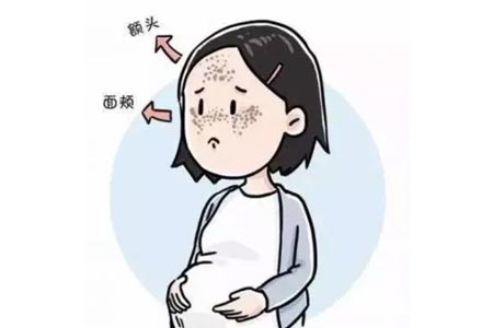 生完宝宝后脸上有很多妊娠斑怎么去除