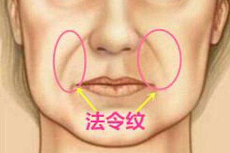 脸部法令纹很深要怎么才能去除