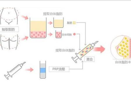 胸部做自体脂肪填充要多久恢复自然