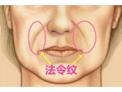 脸部法令纹很深要怎么才能去除