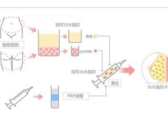 胸部做自体脂肪填充要多久恢复自然