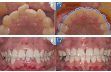 牙齿隐形矫正优点