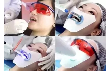 牙齿美白哪种方法好