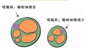 上海吸脂手术可以瘦多少斤