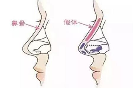 自体软骨隆鼻整形手术过程是怎样的