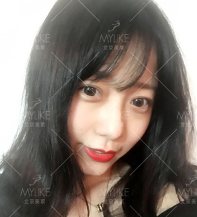 怎么看出自己适合什么双眼皮，美莱医生教你