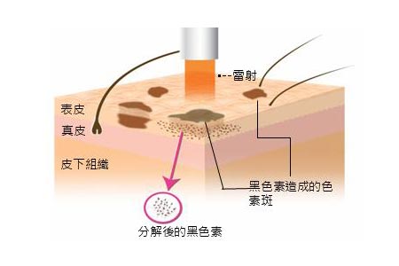 怎么才能快速祛斑还不反弹