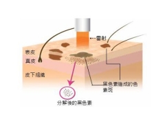 怎么才能快速祛斑还不反弹