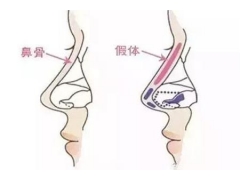 做了假体隆鼻整形术后应该怎么护理