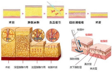 美莱超柔性吸脂五大优势让你脂肪消消乐