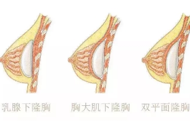 影响假体隆胸的因素有哪些？