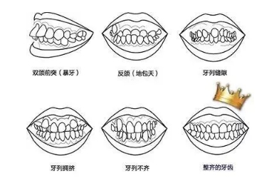 隐适美能矫正哪类的牙齿？隐适美有优势是什么？