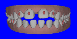 隐适美能矫正哪类的牙齿？隐适美有优势是什么？