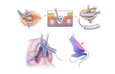 肋软骨隆鼻是什么？肋软骨隆鼻有什么好处？