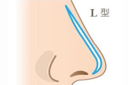 假体隆鼻整形手术优势有哪些