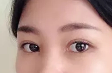 哪些类型的眼睛要做修复？