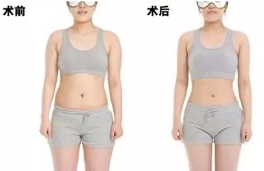 吸脂后为何要穿塑身衣？