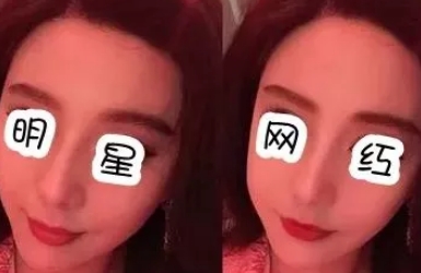 什么脸型不适合脂肪填充