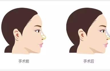 鼻整形术后注意事项有哪些