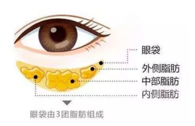 祛眼袋常用的四种方式，你适合哪种?