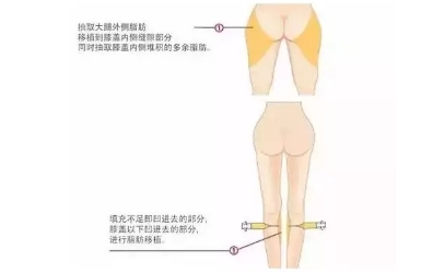 自体脂肪如何改善O型腿