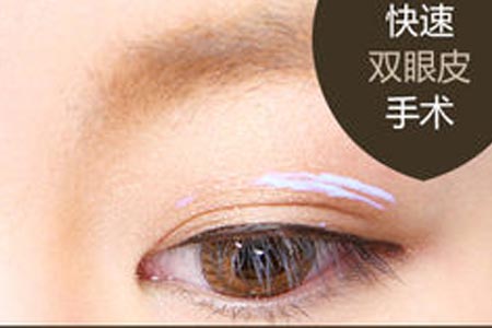 上海做双眼皮整形手术费用是多少钱